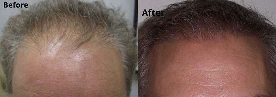 Neograft Before And After Image
